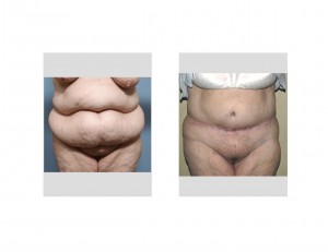 Tummy Tuck with gallbladder scar result front view Dr Barry Eppley Indianapolis
