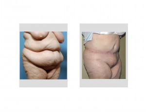 Tummy tuck with gall bladder scar results oblique view Dr Barry Eppley Indianapolis