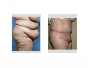 Tummy tuck with gall blader scar results side view Dr Barry Eppley Indianapolis