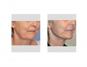 Facelift with Chin Implant result oblique view Dr Barry Eppley Indianapolis