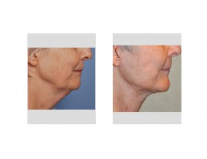 Facelift with Chin Implant result side view Dr Barry Eppley Indianapolis