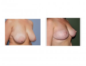 Full Breast Lift results oblique view Dr Barry Eppley Indianapolis