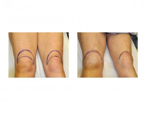 Knee Lift Indianapolis Dr Barry Eppley