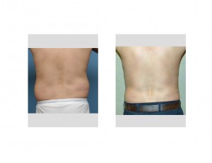 Male Abdominal and Waistine Liposuction Contouring result back view Dr Barry Eppley Indianapolis