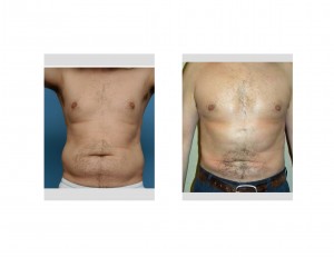 Male Abdominal and Waistline Liposuction Contouring result frnt view Dr Barry Eppley Indianapolis