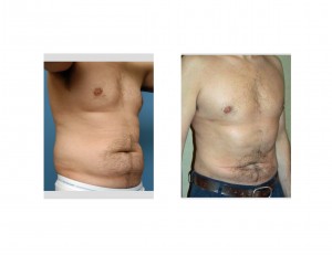 Male Abdominal and Waistline Liposuction Contouring result oblique view Dr Barry Eppley Indianapolis