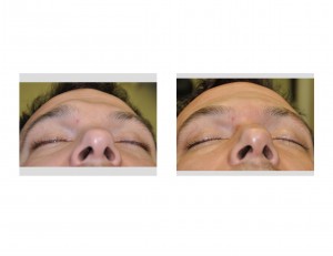 Right Brow Bone Reduction result below view