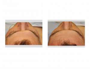 Right Brow Bone Reduction result top view
