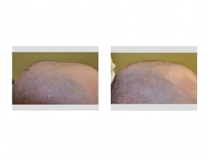Sagittal Ridge Skull Reduction result intraop Dr Barry Eppley Indianapolis