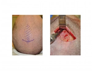 Sagittal Ridge Skull Reduction technique Dr Barry Eppley Indianapolis