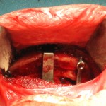 Sliding Genioplasty for Sleep Apnea Dr Barry Eppley Indianapolis