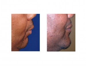 Sliding Genioplasty fpr Sleep Apnea result Dr Barry Eppley Indianapolis