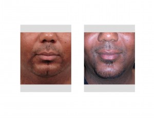 Sliding Genioplasty result for Sleep Apnea front view Dr Barry Eppley Indianapolis