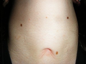 Tracheostomy Scar Revision Surgery Indianapolis Dr Barry Eppley
