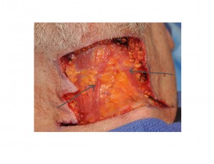 Direct Neck Lift plastysmal muscle separation