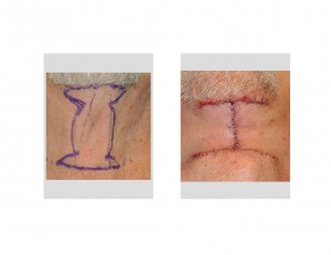 Direct Necklift Incision pattern Dr Barry Eppley Indianapolis