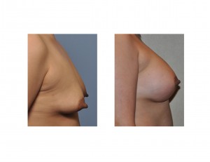 Female Nipple Reduction Dr Barry Eppley Indianapolis