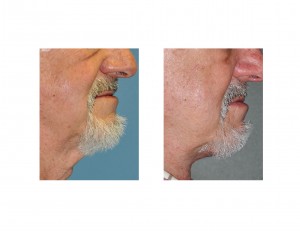 Male Direct Necklift result Dr Barry Eppley Indianapolis