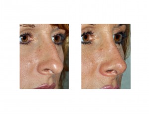 Natural Rhinopasty by Dr Barry Eppley Indianapolis