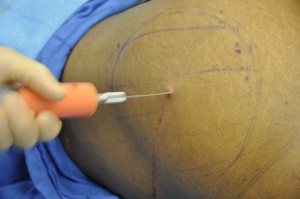 Buttock Fat Injections Dr Barry Eppley Indianapolis