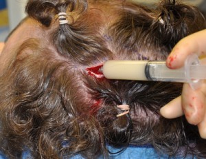 Injectable Cranioplasty for Skull Dimples (Skull Dimpleplasty) Dr Barry Eppley Indianapolis