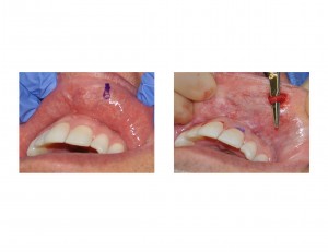 Labial Artery Aneurysm Dr Barry Eppley Indianapolis