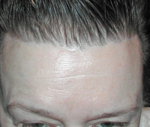 Pretrichial Open Browlift Scar Dr Barry Eppley Indianapolis