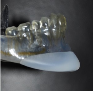 vertical lengthening chin implant indianapolis dr barry eppley