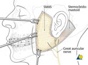 Greater Auricular Nerve in Facelifts Dr Barry Eppley Indianapolis