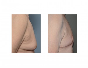 Gynecomastia Reduction and Nipple Transposition result side view
