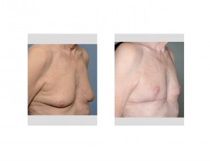 Older Male Gynecomastia Reduction with Nipple Lifts result Dr Barry Eppley Indianapolis