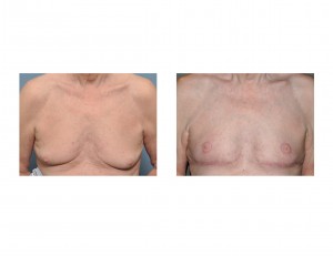 Older Male Gynecomastia Reduction with Nipple Transposition front view Dr Barry Eppley Indianapolis