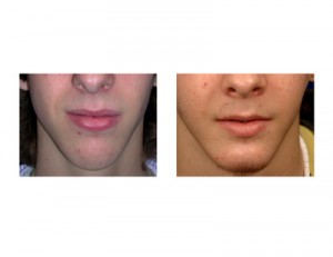 Sliding Genioplasty result front view Dr Barry Eppley Indianapolis