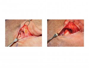 Temporal Widening Implants Surgical Placement Dr Barry Eppley Indianapolis