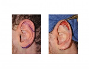 Vertical Ear Reduction Technique (Scapha Reduction) Dr Barry Eppley Indianapolis