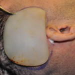 temporal implant size dr barry eppley indianapolis