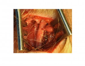 Great Occipital Nerve Decompression Surgery for Migraines Dr Barry Eppley Indianapolis