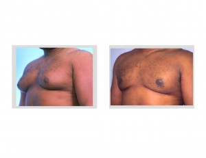 Gynecomastia Reduction Dr Barry Eppley Indianapolis