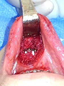 Hydroxyapatite Granules in Sliding Genioplasty Dr Barry Eppley Indianapolis