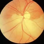 Retinal Artery Occlusion from Injectable Fillers Dr Barry Eppley Indianapolis