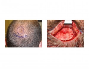 Skull Dimple before and intraop Dr Barry Eppley Indianapolis