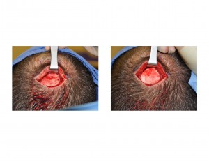 Skull Dimpleplasty Dr Barry Eppley Indianapolis