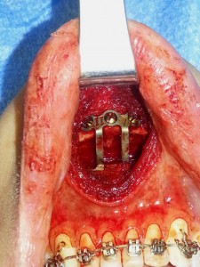 Sliding Genioplasty Dr Barry Eppley Indianapolis