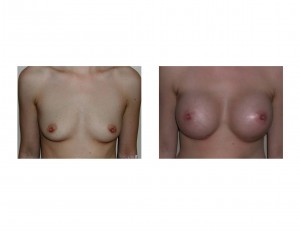 Breast Augmentation (Easy Aug) Indianapolis Dr Barry Eppley