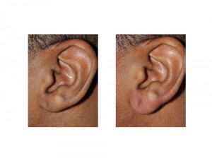 Earlobe Lengthening by Injection Dr Barry Eppley Indianapolis