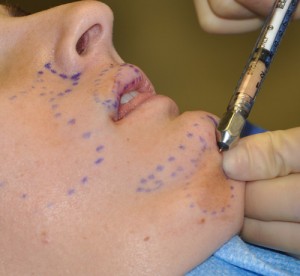 Facial Fat Injections for Linear Scleroderma Dr Barry Eppley Indianapolis