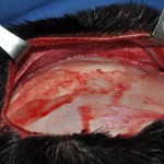 Hydroxyapatite Bone Cement Occipital Augmentation Dr Barry Eppley Indianapolis