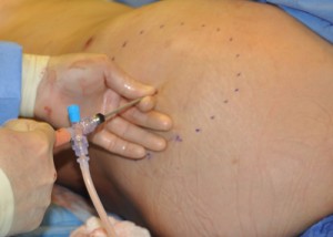 Indianapolis Buttock Fat Injections Dr Barry Eppley