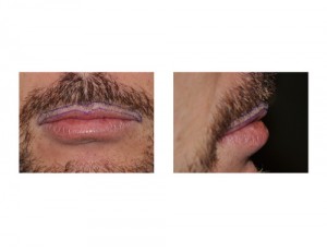 Male Lip Advancement markings before surgery Dr Barry Eppley Indianapolis