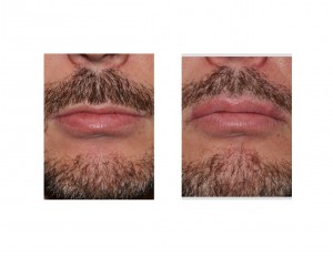 Male Upper Lip Advancement result fronkt view